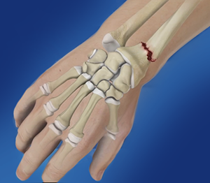 Colles' Wrist Fracture: Causes, Treatment, and Fracture