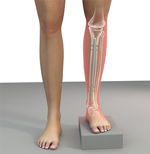 Leg Length Discrepancy After Hip Replacement